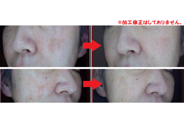 beforeafterskin